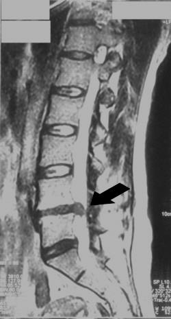 Diskus-hernija
